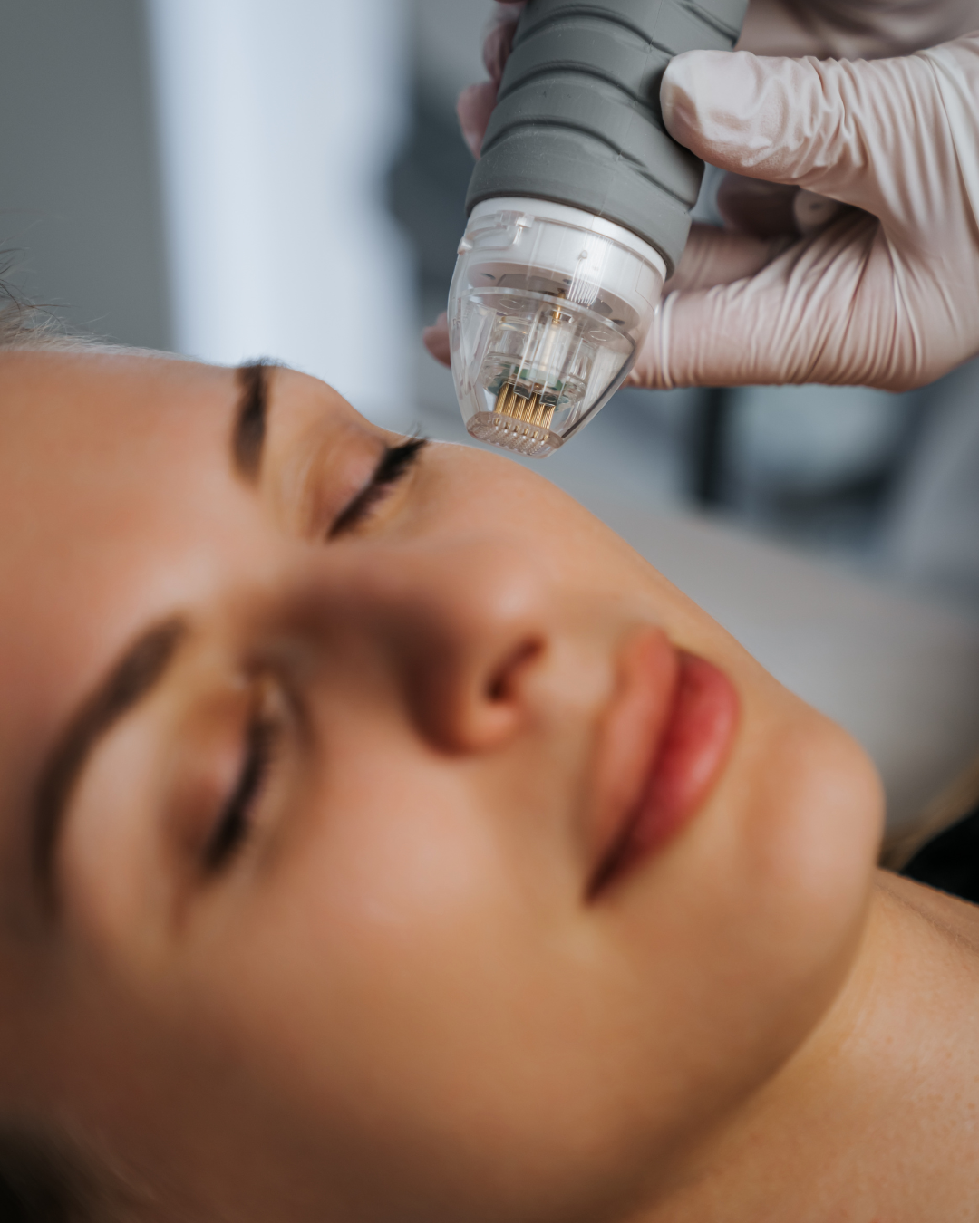 Salmon Exosome Skin Needling