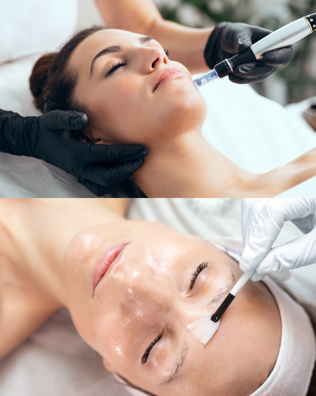 Microneedling vs Chemical Peels